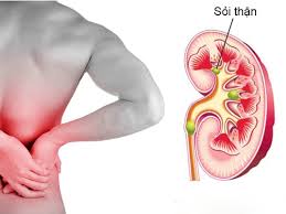 đau hông bên trái có khả năng bị sỏi thận